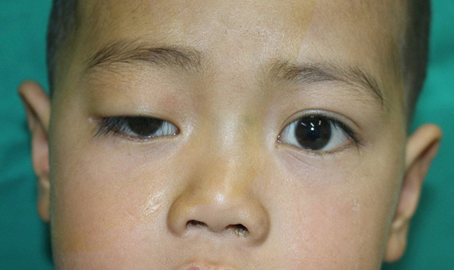 Sụp mí mắt bẩm sinh (Congenital ptosis)